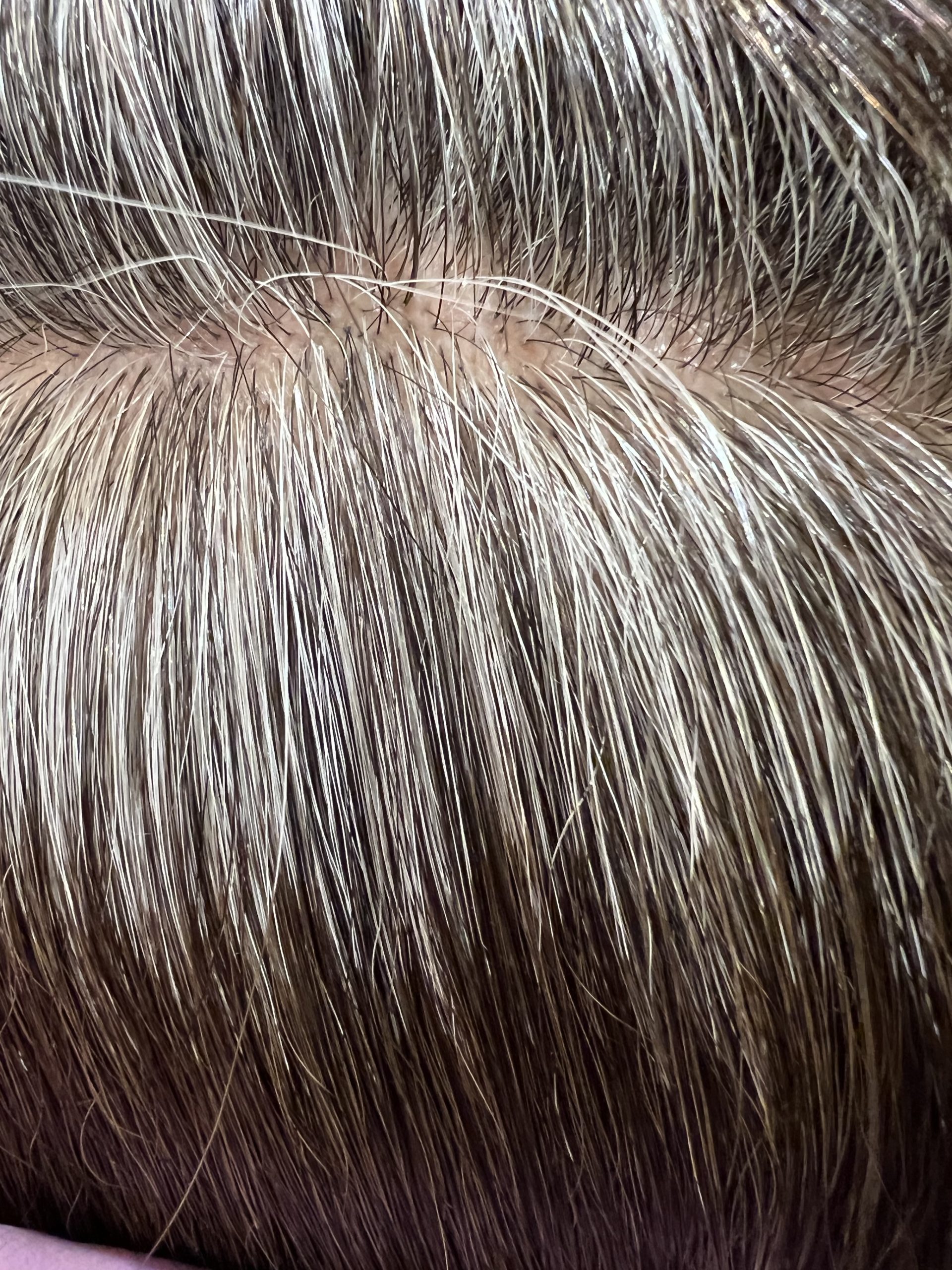 白髪減少✖️高発生医療水素