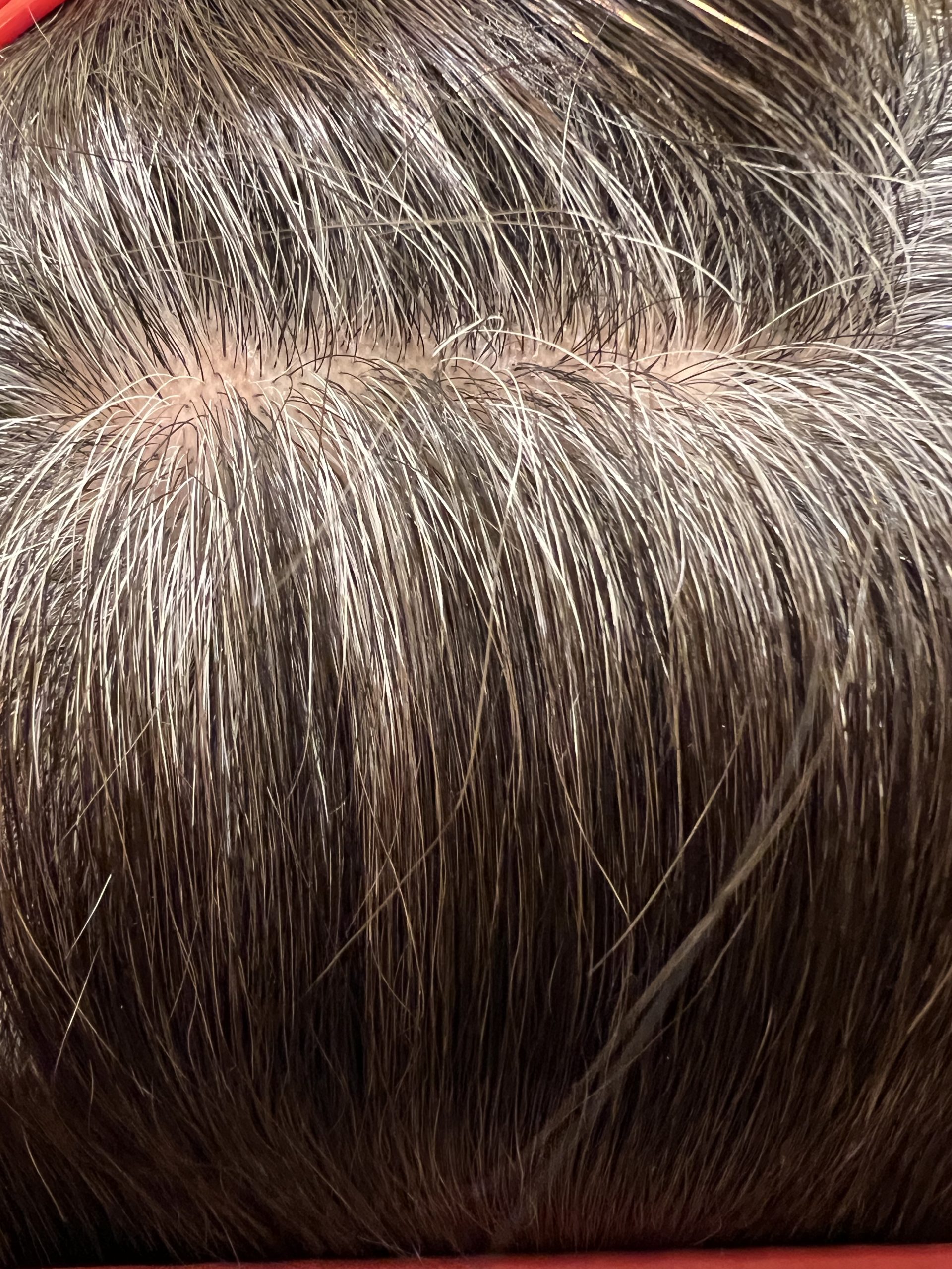 白髪減少抑制効果には高発生医療水素