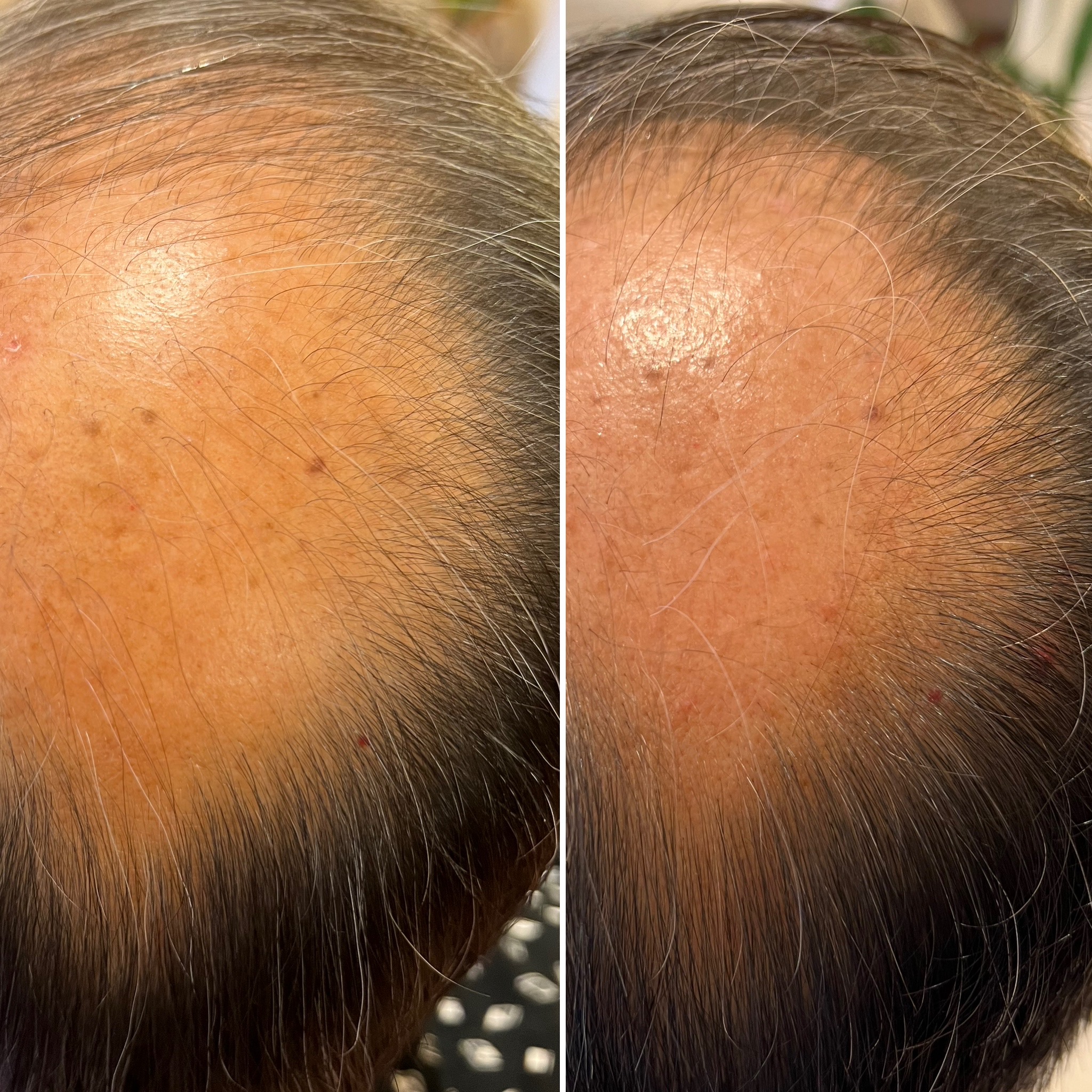 人羊水幹細胞発毛９ヶ月60代男性リバースエイジングプレミアム